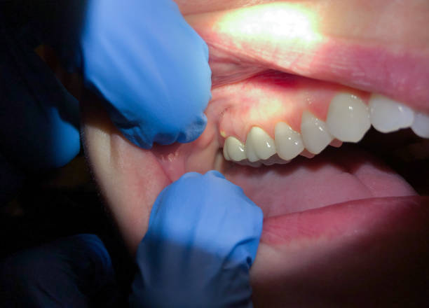 Best Emergency Dental Extractions in Ossian, IN