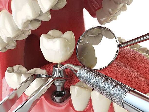 Best Emergency Dentist for Knocked-Out Tooth in Ossian, IN