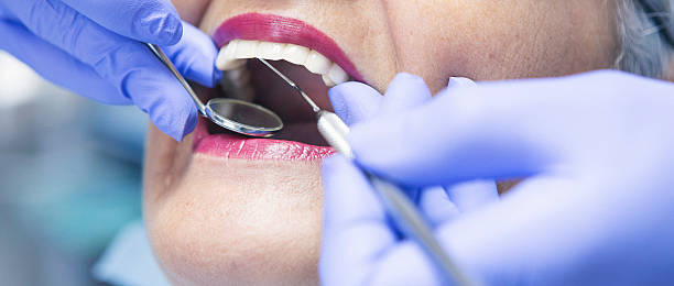 Best Emergency Dentist for Lost Fillings or Crowns in Ossian, IN