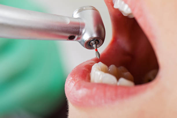 Best Emergency Root Canal Treatment in Ossian, IN
